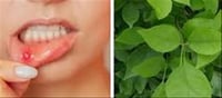 Mouth Ulcer Trouble? Acharya Balkrishna Recommends Tulsi Leaf Remedy